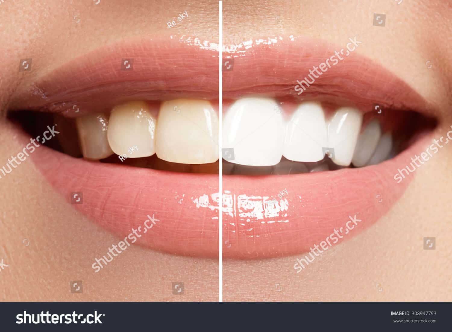 1 triệu 700 ngàn hình ảnh răng chất lượng cao trên Shutterstock